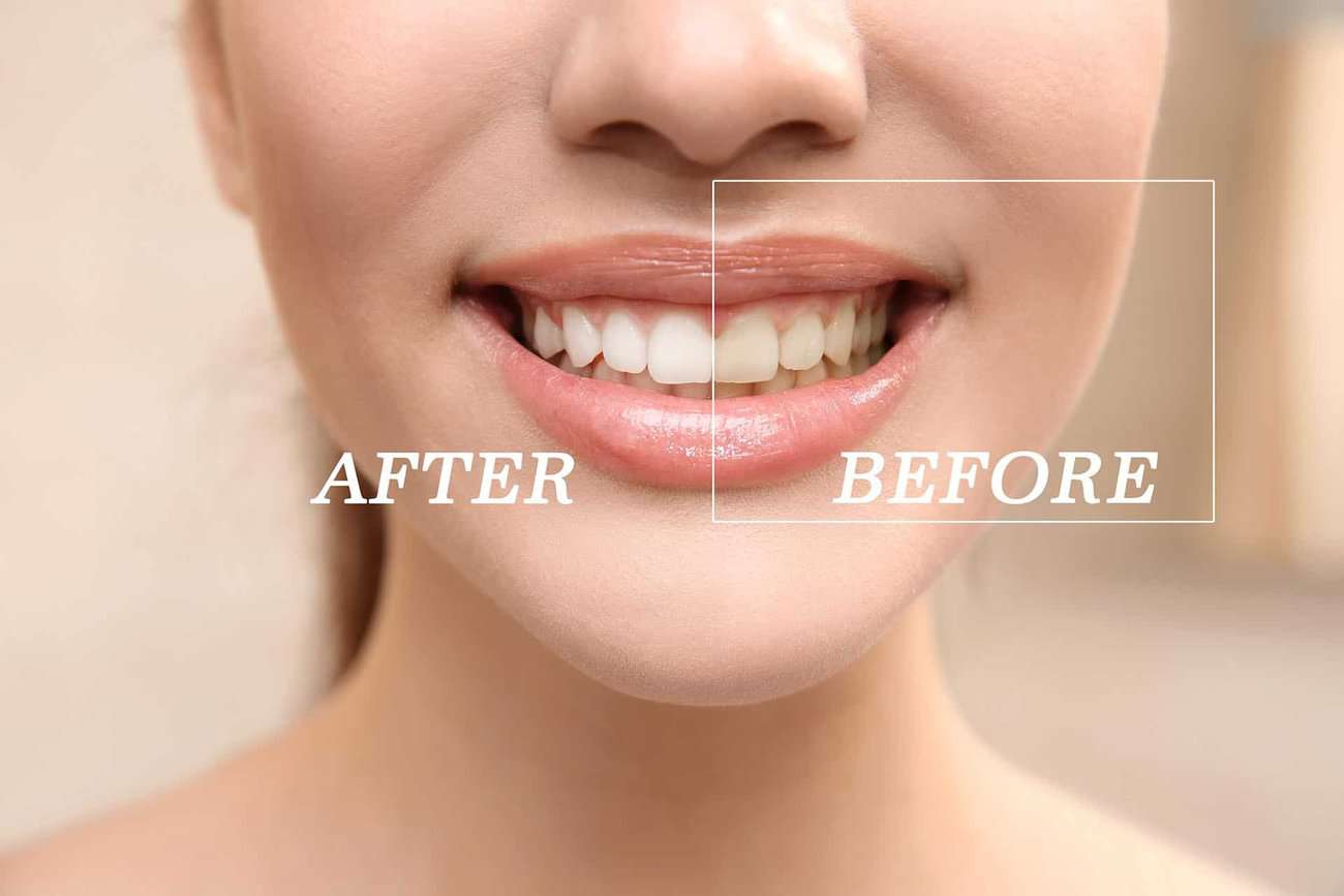 How Can You Maintain a Consistent Smile Shade with Crowns Hempstead?