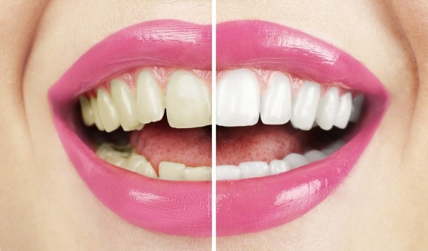 What Makes Ultima White Teeth Whitening Different Hempstead