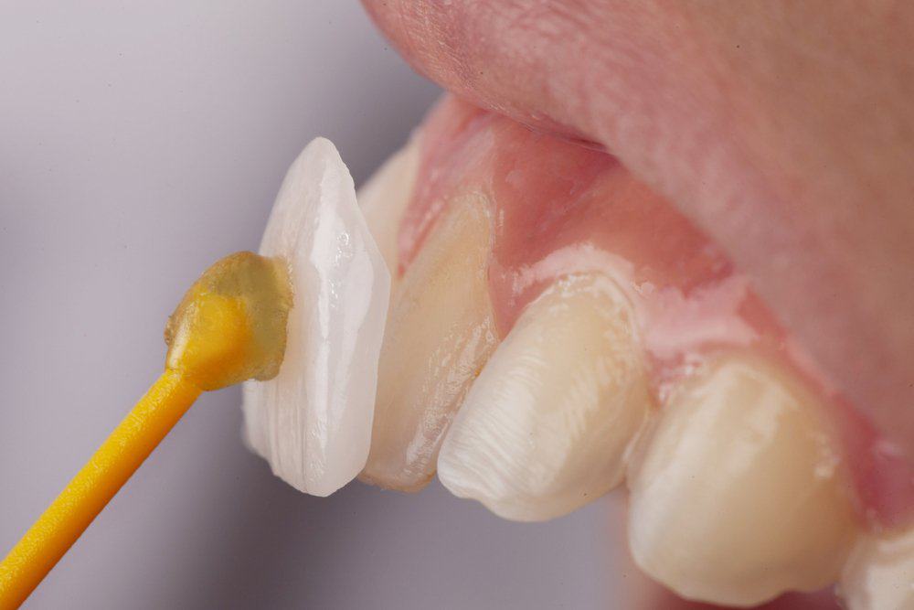 Why Do Dental Crowns Fail or Get Damaged Prematurely Hempstead?