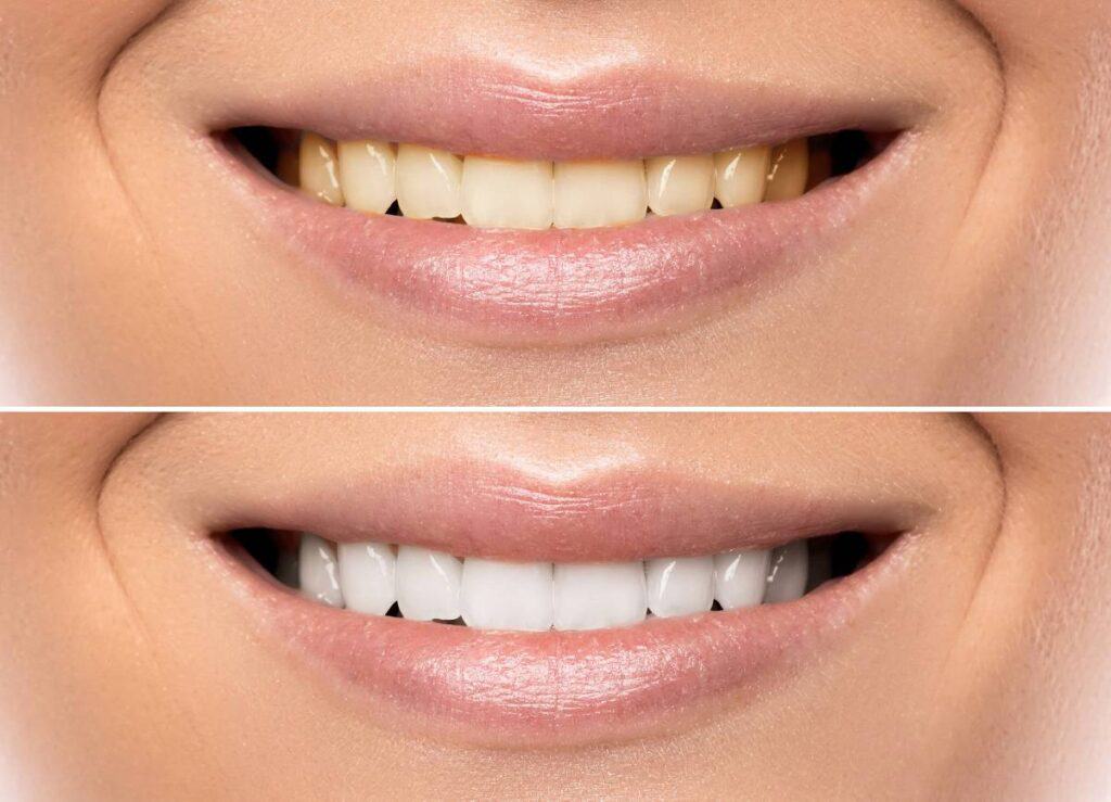 How Does Gum Disease Progress if Left Untreated Hempstead?