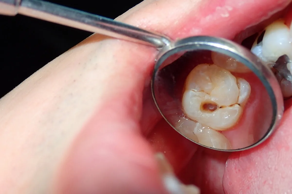 Why Do Teeth Crack? Common Causes to Know Hempstead