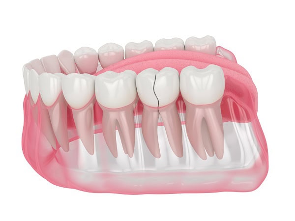 How Can You Manage Pain and Discomfort After a Root Canal Hempstead?