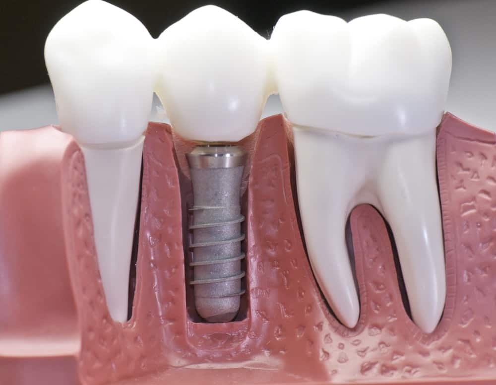 Common Misconceptions About Modern Dental Treatments Hempstead