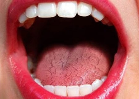 Dry Mouth and Its Role in Tooth Decay Hempstead