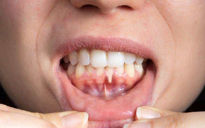How Can Gum Disease Be Prevented Hempstead?