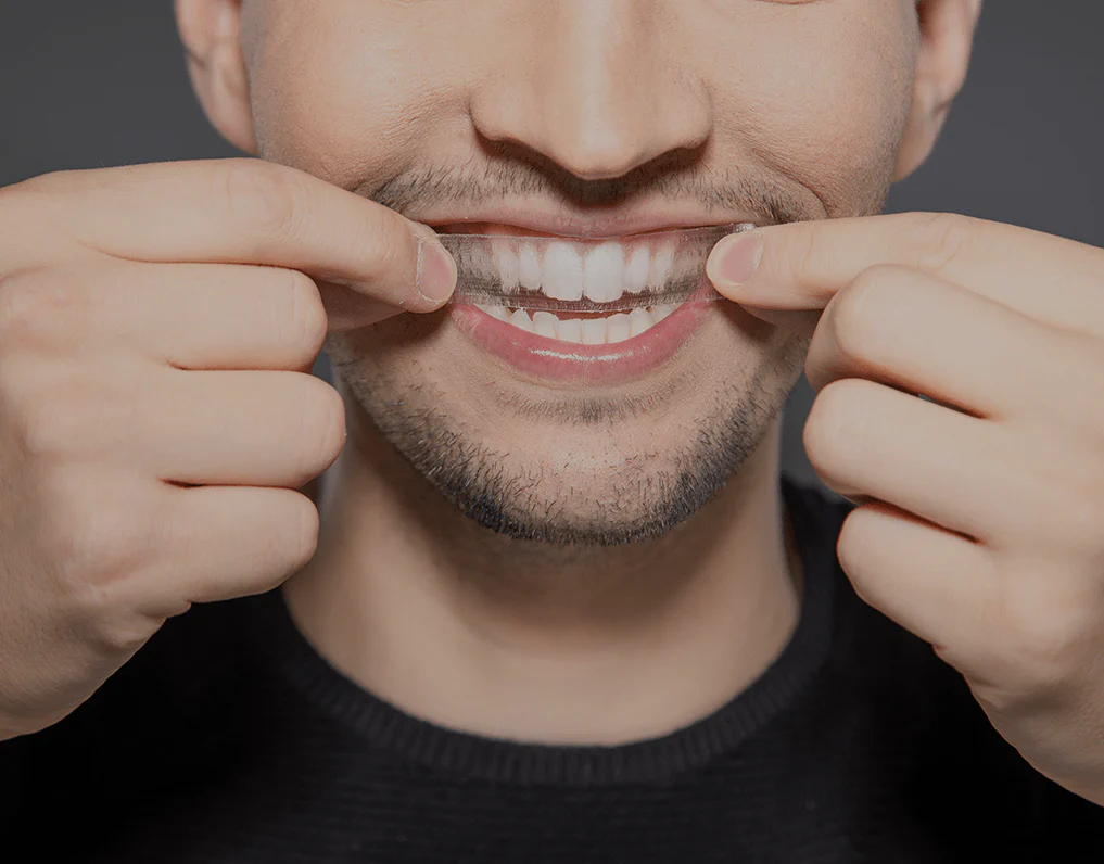 What to Consider Before Choosing a Teeth Whitening Option Hempstead