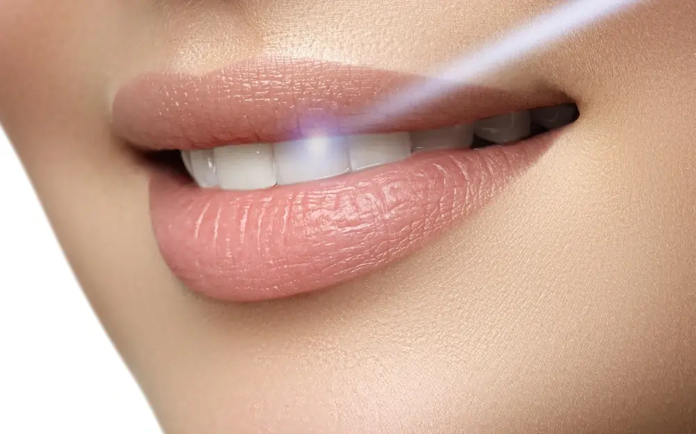 How Long Does Laser Teeth Whitening Last on Your Teeth Hempstead?