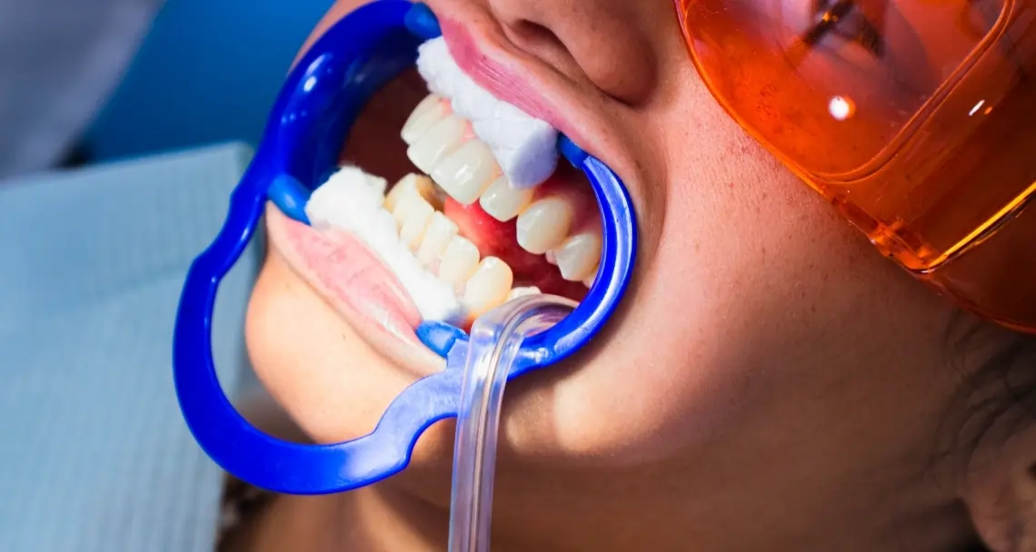 Why At-Home Laser Teeth Whitening Is Faster Hempstead