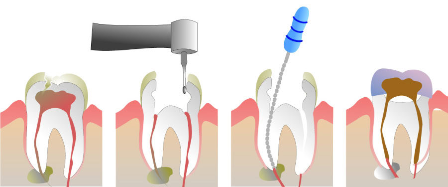 How Do You Properly Care for Your Teeth After a Root Canal Hempstead