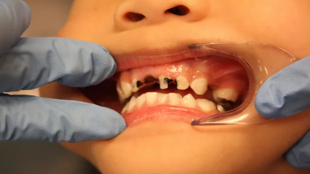 Tips for Keeping Your Child’s Baby Teeth Healthy and Strong Hempstead