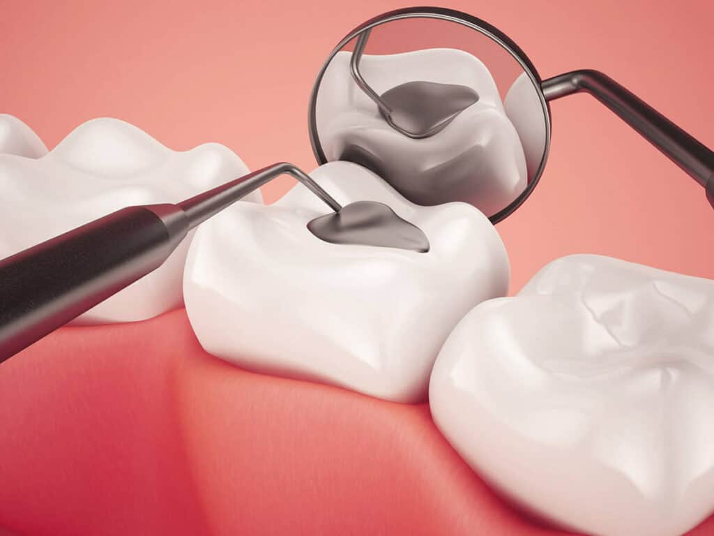 How Can You Prevent Tooth Decay Effectively Hempstead