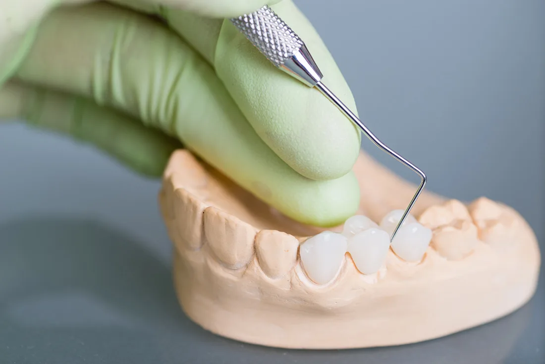 Do Braces Take Years to Show Results Hempstead