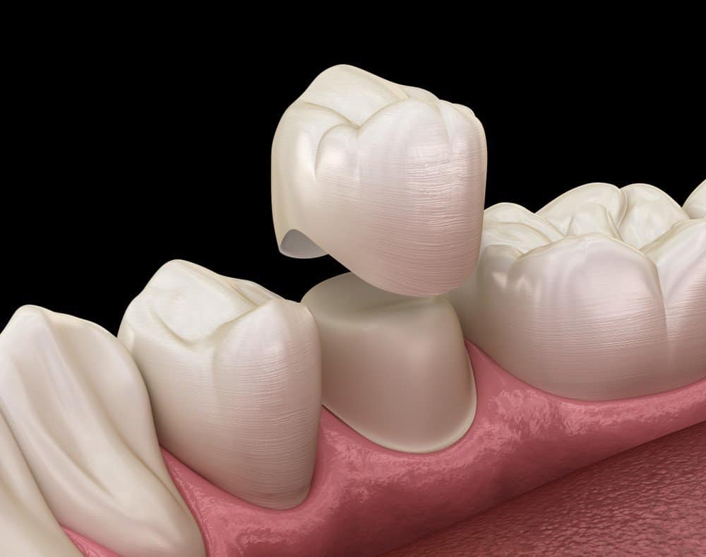 How Can You Prevent Common Dental Crown Problems Hempstead?