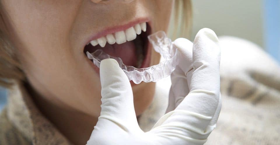 Why Bleaching Trays Require More Time Hempstead