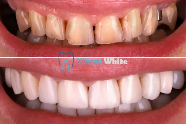 What Makes Instant Teeth Whitening Treatments So Popular Hempstead?