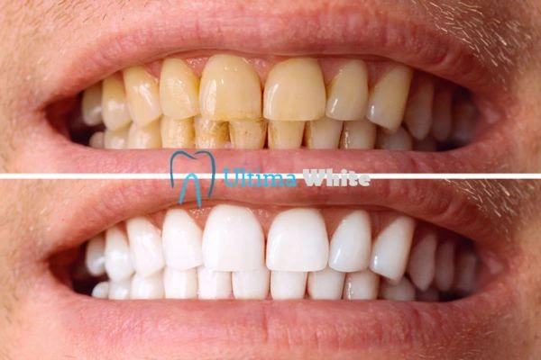 Stained Teeth and Persistent Bad Breath Hempstead