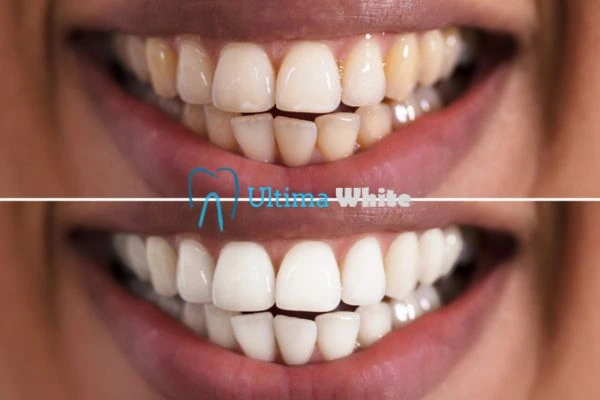 Aftercare Tips to Maintain Your New Smile Hempstead